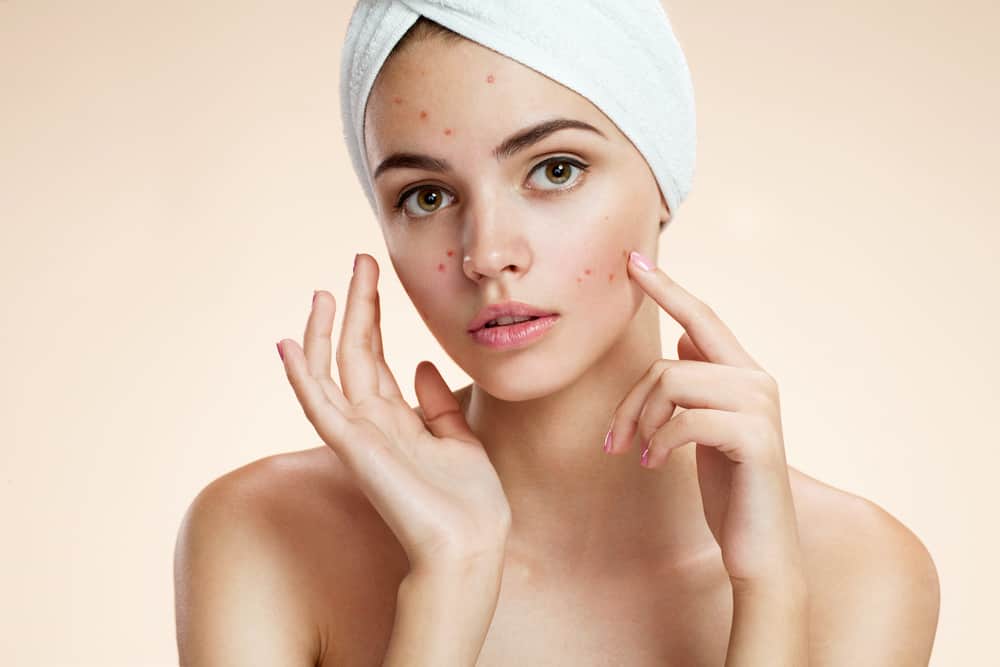 Scowling girl pointing at her acne with a towel on her head.